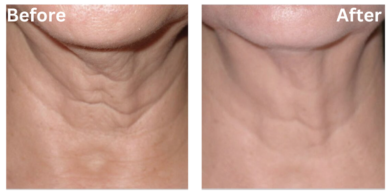 Results Permanent Choice Permanent Choice Laser Hair Removal